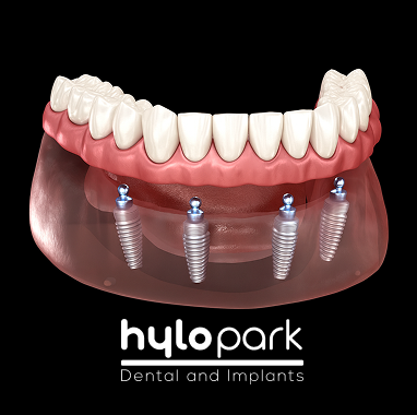 Zirconia Implant Bridge