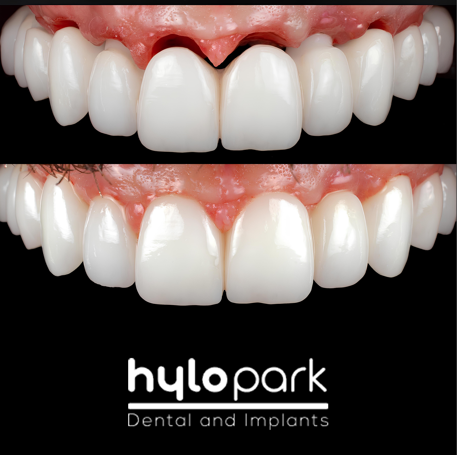 Porcelain Implant Bridge